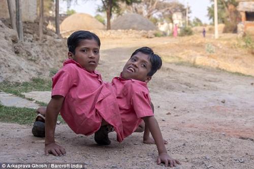 Conjoined-twins-Shivanath-Shivram-Sahu-20140411231322