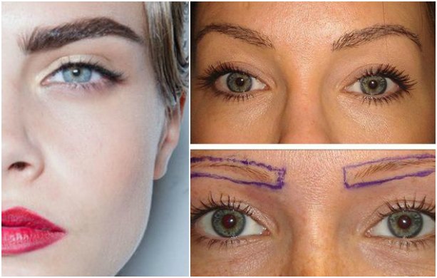 Implantes de cejas, la nueva tendencia