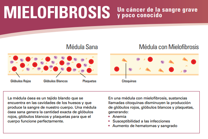 ¿Sabes que es la mielofibrosis?