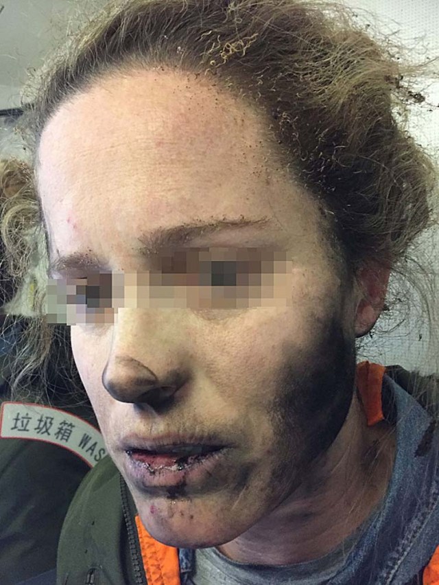 AAP01. MELBOURNE (AUSTRALIA), 14/03/2017.- Fotografía sin fecha cedida hoy, miércoles 15 de marzo de 2017, por la Oficina de Seguridad de Transporte de Australia (ATSB), muestra a una mujer con lesiones faciales después de que los auriculares que llevaba explotaran durante un vuelo desde Pekín (China) a Melbourne (Australia). La ATSB ha advertido a la gente que tenga cuidado con el uso de dispositivos de batería en los aviones. EFE /Oficina de Seguridad de Transporte de Australia (ATSB)/MEJOR CALIDAD DISPONIBLE/ATENCIÓN EDITORES: FOTOGRAFÍA PIXELADA DESDE LA FUENTE/PROHIBIDO SU USO EN AUSTRALIA Y NUEVA ZELANDA/SOLO USO EDITORIAL/NO VENTAS