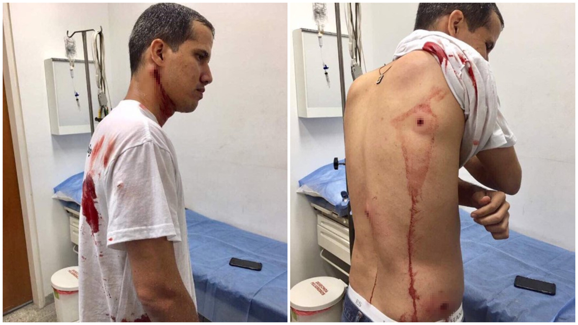 Las heridas que le ocasionó la GNB al diputado Juan Guaidó (+Imágenes fuertes)