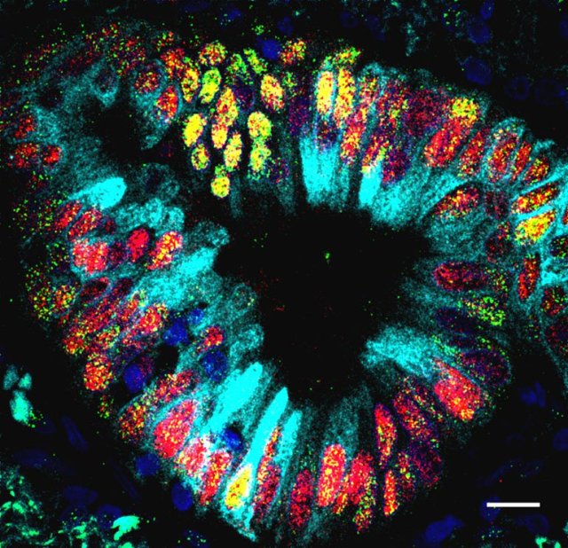 Foto: Descubren un sistema digestivo completo dentro de un tumor de pulmón / sciencealert.com