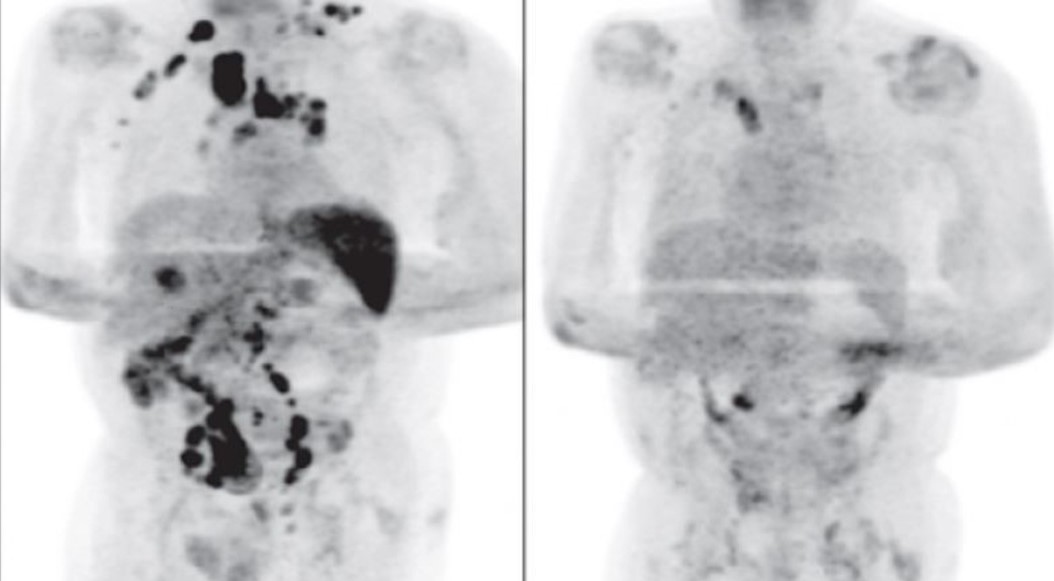 Sufría linfoma de Hodgkin y se curó tras contagiarse de coronavirus