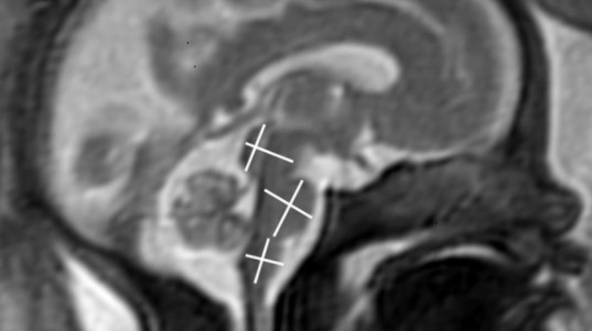 Expertos responden: ¿Tener Covid-19 durante el embarazo daña el cerebro del feto?