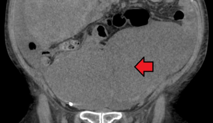 El alimento habitual que duplica la posibilidad de sufrir cáncer de colon, según estudio