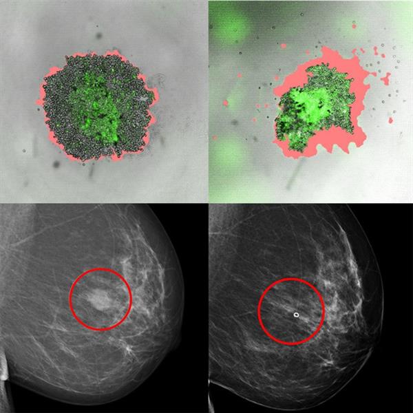 Cáncer de mama: El nuevo método para buscar el mejor fármaco para cada paciente