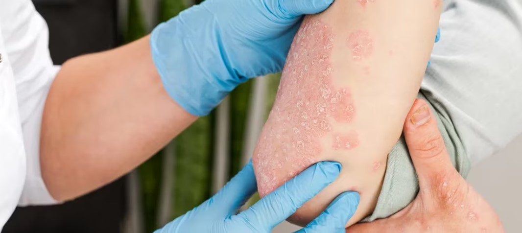 ¿Psoriasis puede influir en los procesos de ansiedad y depresión?