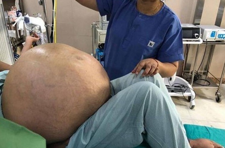 Extirpan un tumor de más de 50 kilos del abdomen de una mujer en Italia