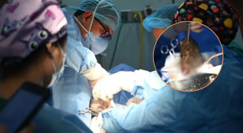 Médicos sacaron pesada bola de pelos del estómago de una niña para salvarle la vida