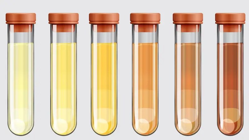 Presta atención: qué significa el color de tu orina y cuándo debes preocuparte